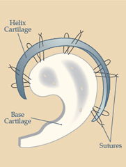 Integrated Cartilage Graft