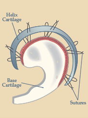 Integrated Cartilage Graft
