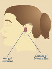 Trouvé Medspa - Earlobe Augmentation