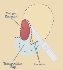 Trouvé Medspa - Earlobe Augmentation