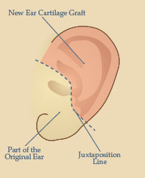 Juxtaposition Ear (JE) | Outer Ear Reconstruction Surgery