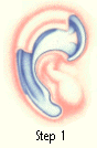 Ear Deformities