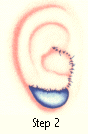Ear Deformities