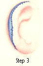 Ear Deformities