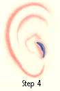 Ear Deformities