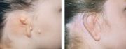 Microtia - a deformed ear - before surgery and after surgery