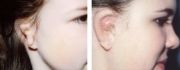 Microtia - a deformed ear - before surgery and after surgery