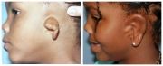 Microtia - a deformed ear - before surgery and after surgery