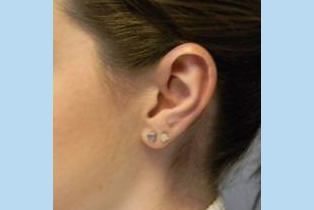 Ear Patient 10 - after