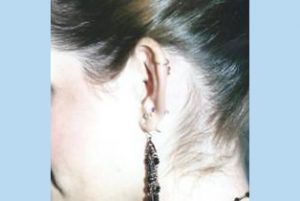 Ear Patient 4 side - before