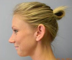 Ear Patient 5 side - before