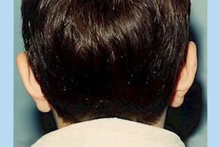 Ear Patient 2 back -after