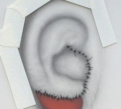 Surgical Procedures Microtia - Earlobe
