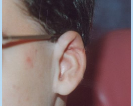 Cryptotia Patient 6 - after