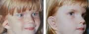 Microtia-Atresia - a deformed ear - before surgery and after surgery
