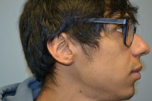 Gauged Earlobe Repair