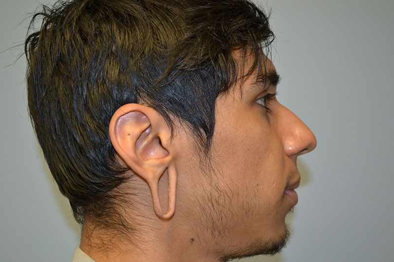 Gauged Earlobe Repair