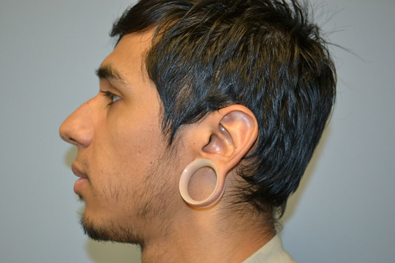 Gauged Earlobe Repair Patients Before and After
