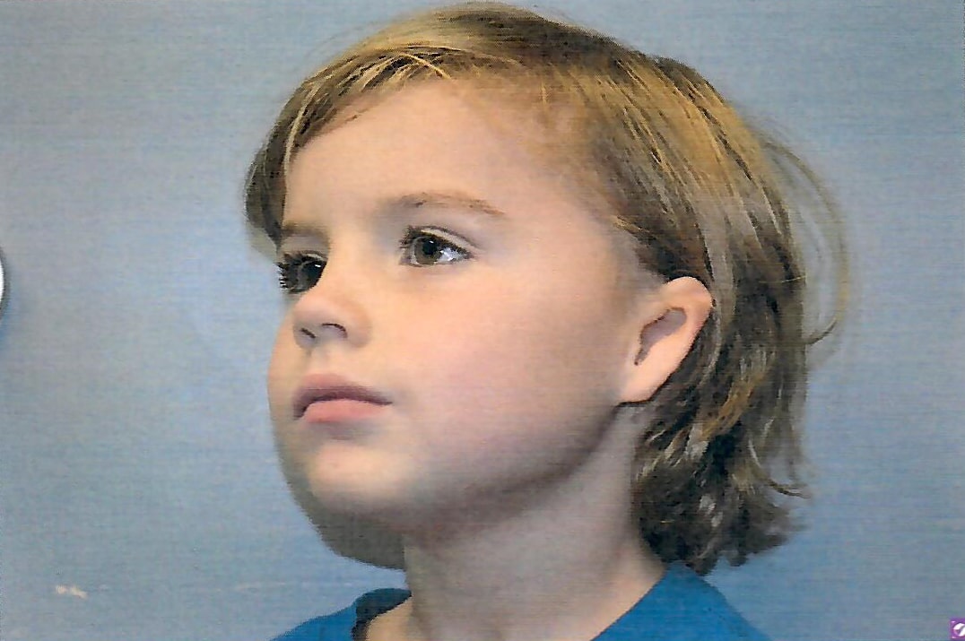 photo of patient before and after microtia ear surgery